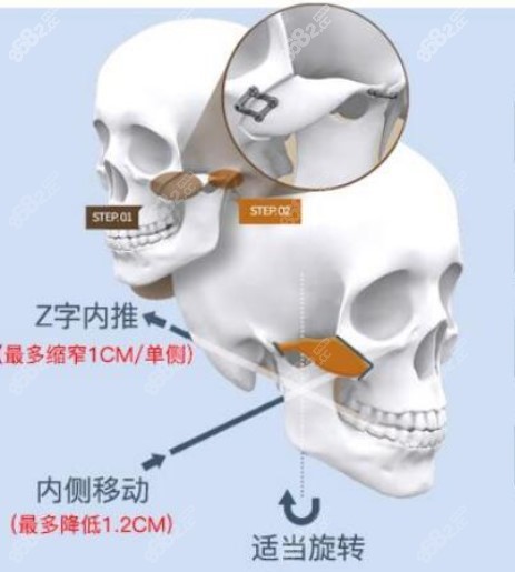 广州杜本军磨骨j技术优势