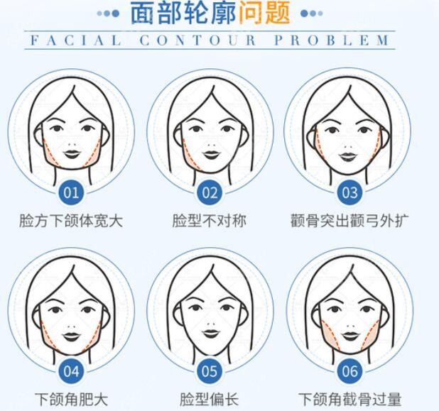 广州磨骨医生解决的面部轮廓不好看症状