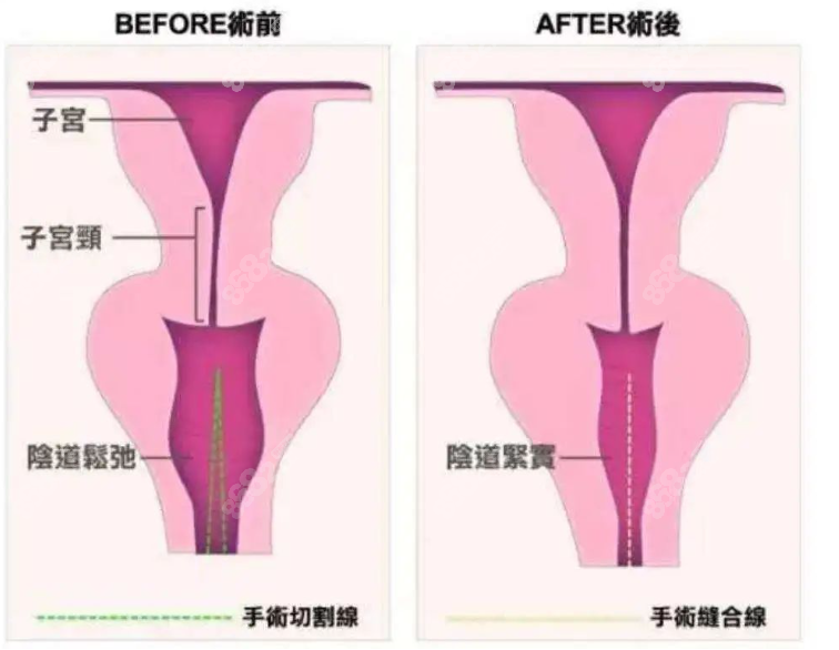 3d生物束带会完全吸收吗