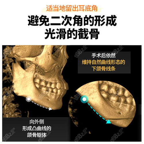 1,韓國ts整形外科醫院磨骨手術:50000元起