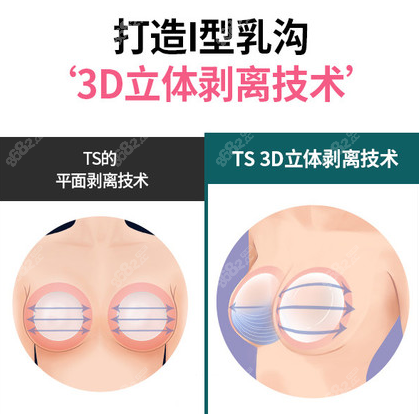 韩国TS整形假体隆胸优势