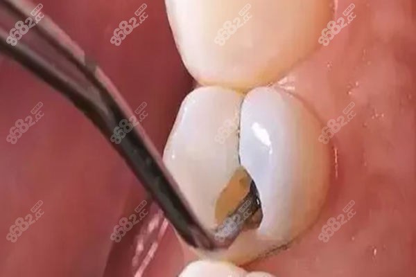 都匀补牙多少钱