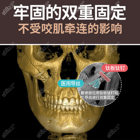 韩国TS整形颧骨内推优势