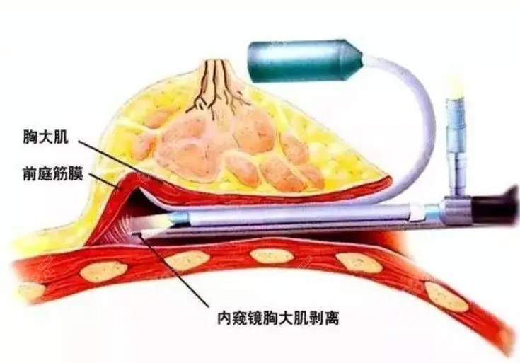 果冻丰胸技术特色