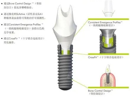 瑞士iti种植牙