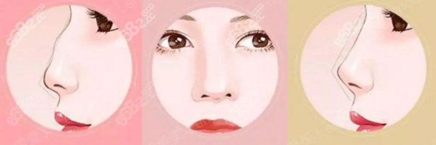 孙玥玥医生做鼻子如何www.8682.cc