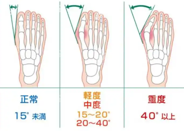 国内可以做中重度大脚骨手术的医院