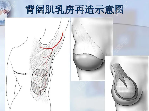 背阔肌再造乳房手术示意图