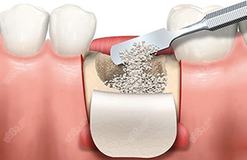 先看下种植牙骨粉填充后多久才能种牙