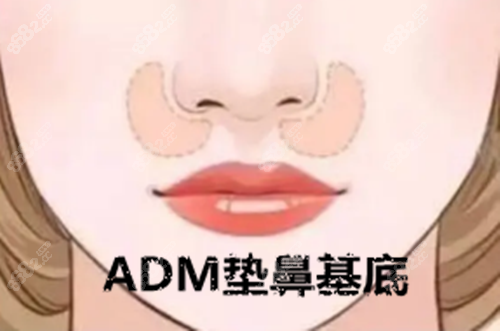 adm真皮垫鼻基底