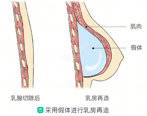 假体乳房再造手术8682.cc