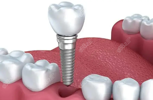 青岛口腔医院种植牙经历*8682网