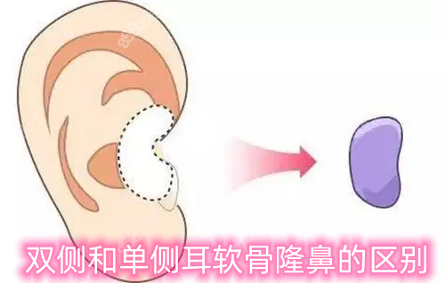 双侧耳软骨和单侧耳软骨隆鼻的区别