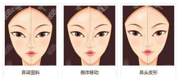 长沙华韩华美孙玥玥鼻子实例