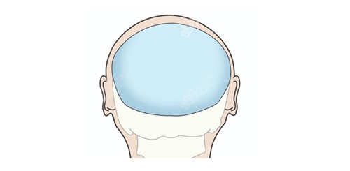 后脑勺填充位置示意