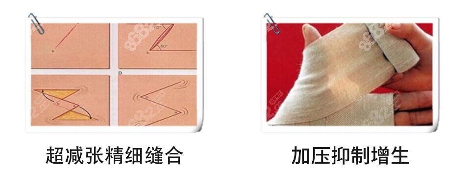 福州玛恩皮肤医院做疤痕技术优势