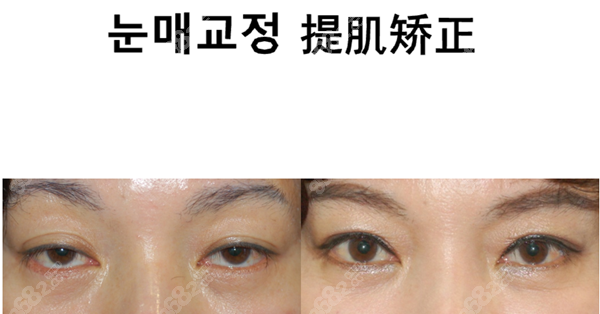 韩国世美眼部提肌矫正手术