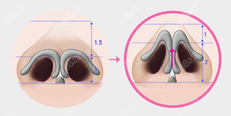 <!--<i data=20240705-sp></i>-->做鼻修复多少钱