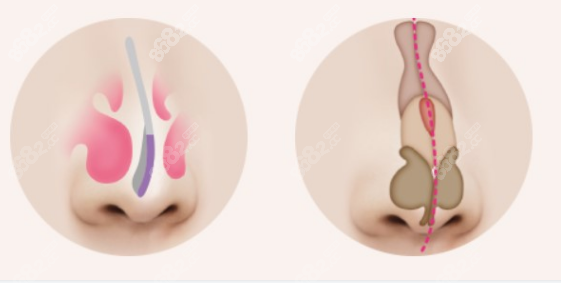 <!--<i data=20240705-sp></i>-->修复鼻子怎么样