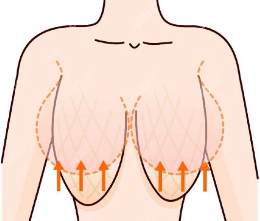 隆胸假体取出后乳房会下垂吗