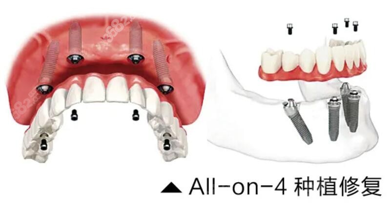 ALL-ON-4种植牙www.8682.cc