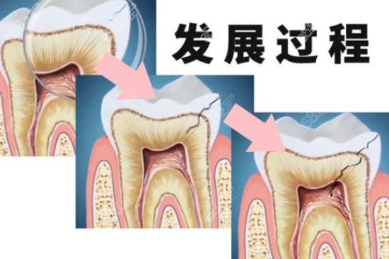 牙隐裂的原因及治疗方法