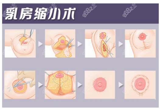 乳房缩小手术过程图8682.cc