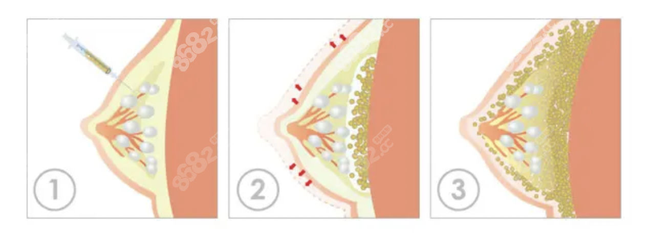 自体脂肪隆胸过程图解