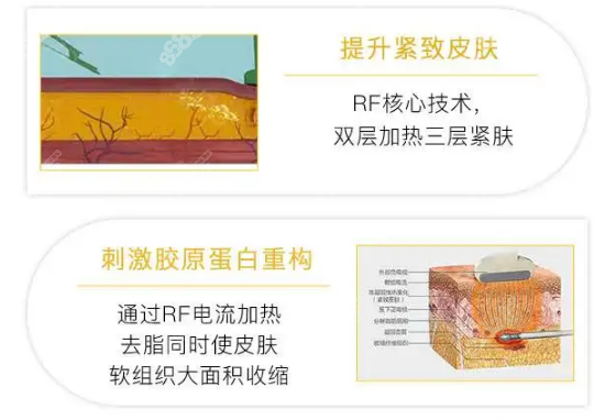 黄金微雕吸脂同时还有紧致的作用