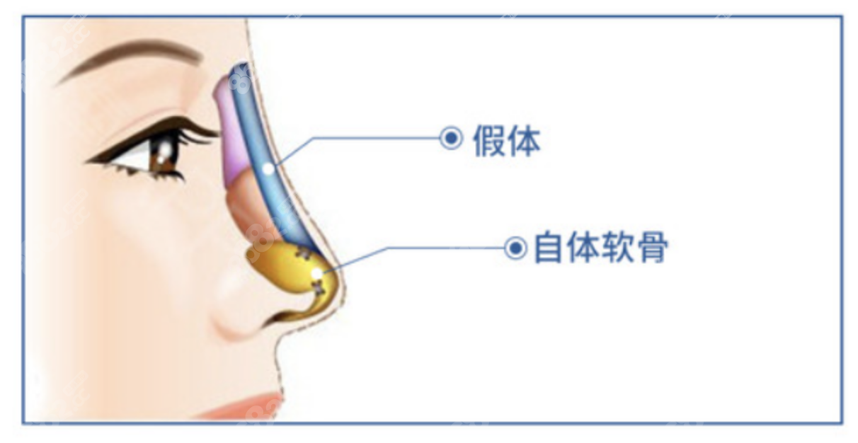 成都艺星隆鼻收费标准