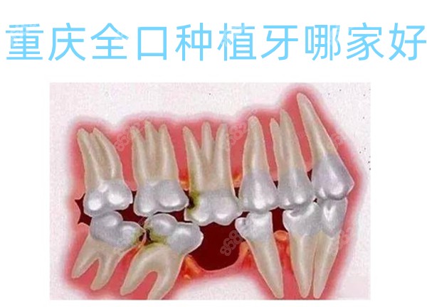 重庆全口种植牙哪家好