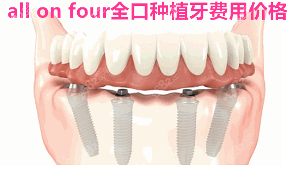 all on four全口种植牙费用价格8682.cc