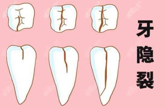 牙隐裂是什么原因引起的