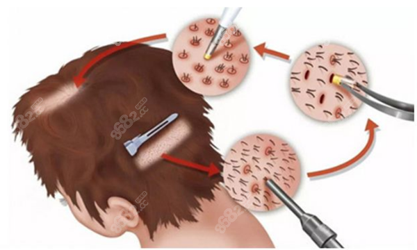 东莞科生毛发移植手术过程