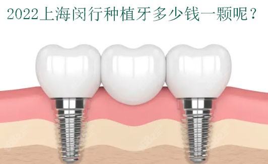 上海闵行种植牙多少钱一颗 上海闵行种植牙多少钱一颗