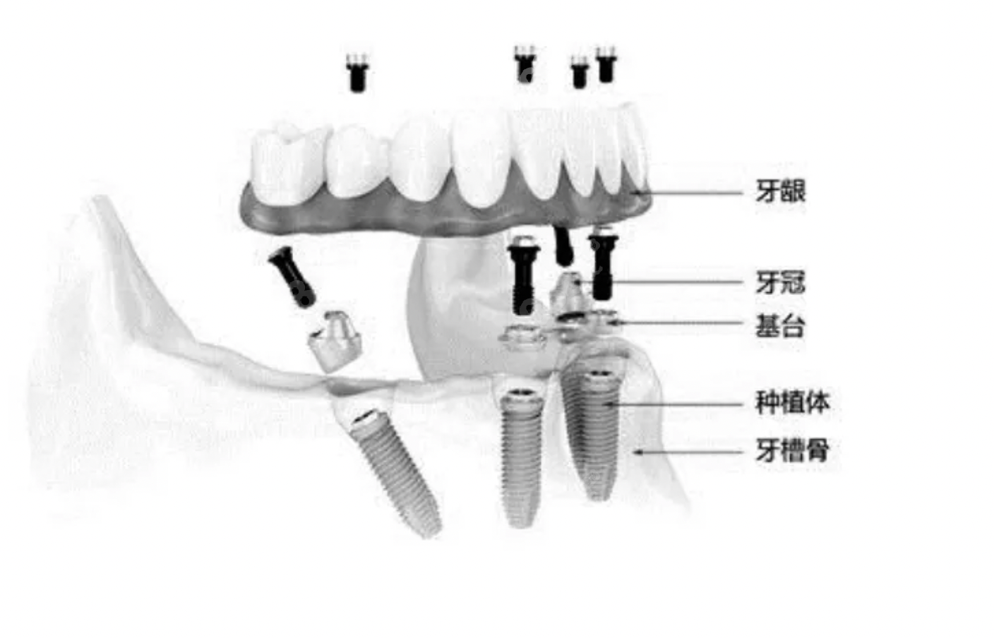 长沙美莱口腔半口种植牙价格：5万-9万元起