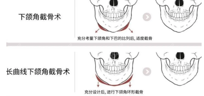 重庆松山医院刘健下颌角怎么样