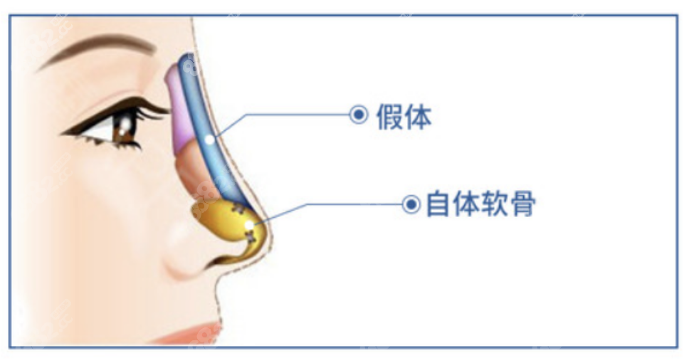 成都艺星隆鼻医生排行www.8682.cc