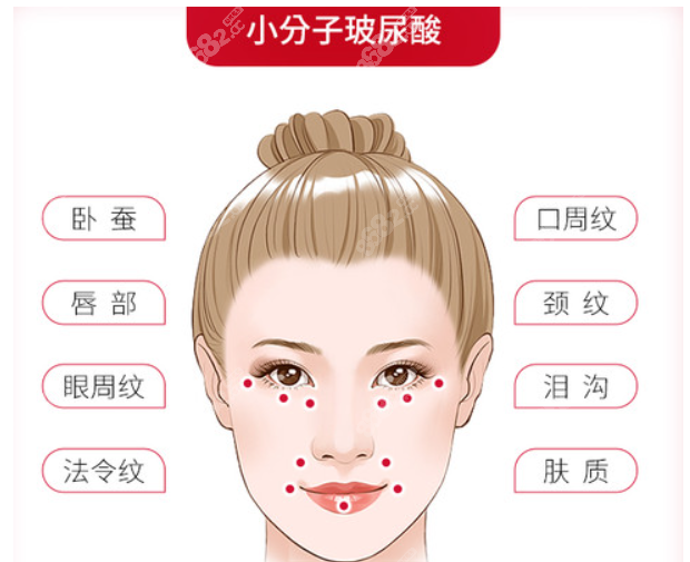 诗如萱盈彩玻尿酸适合填充哪些部位