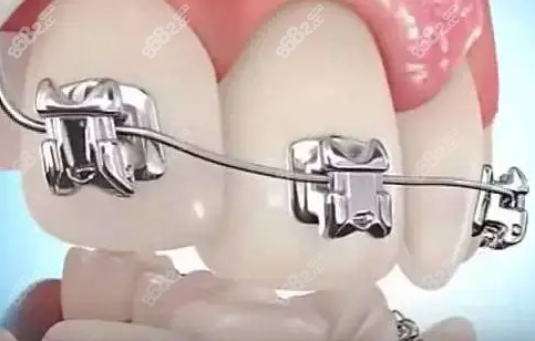 钢丝牙套适应症更广泛8682.cc 钢丝牙套适应症更广泛8682.cc