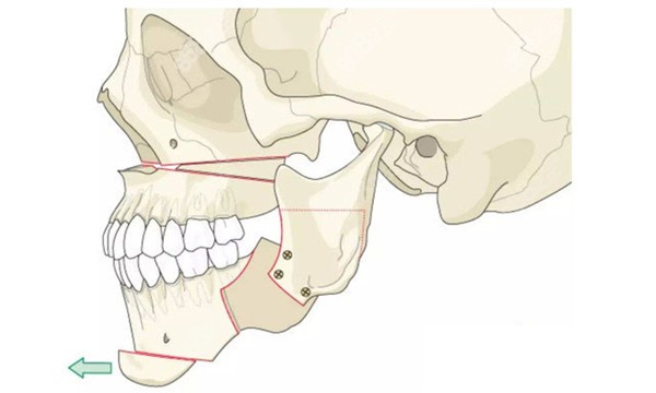 正颌手术单颌和双颌的区别