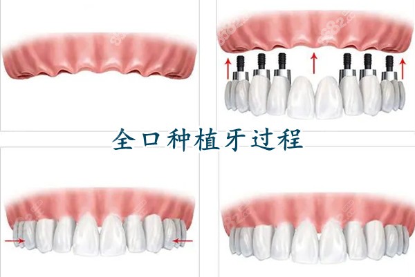 聊城全口种植牙价格