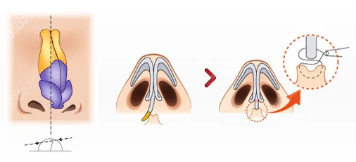 韩国歪鼻整形比较好的医生名单公布www.8682.cc