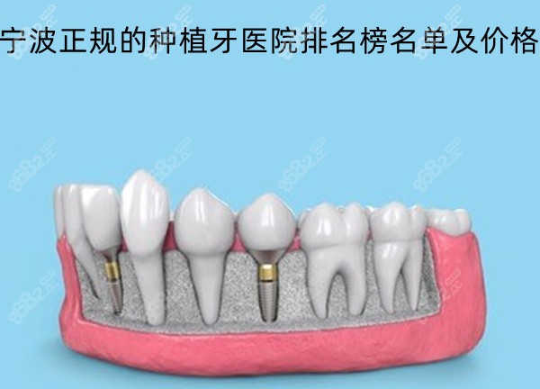 宁波正规的种植牙医院排名榜名单及价格