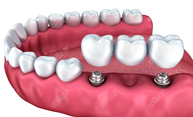 8682.cc闵行种植牙价格在2980元起 8682.cc闵行种植牙价格在2980元起
