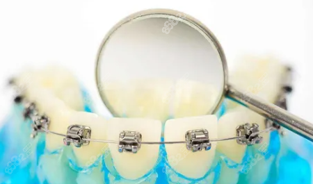 牙齿隐形矫正和钢丝矫正的优缺点 牙齿隐形矫正和钢丝矫正的优缺点