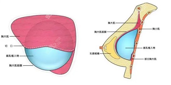 广州隆胸厉害的许扬滨医生做假体隆胸技术特色