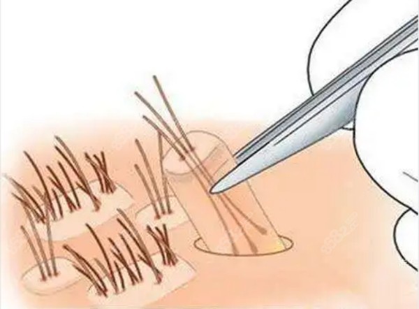 煙臺(tái)正規(guī)植發(fā)醫(yī)院名單