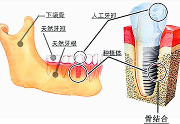 植体在骨头结合的图片www.8682.cc