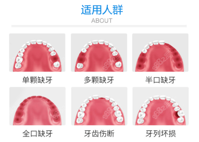 武威宝山口腔常做的种植牙类型图www.8682.cc
